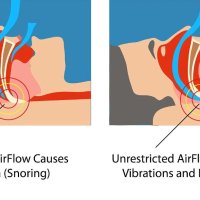 Шина назъбник за уста против хъркане No More Snore, снимка 3 - Други - 42497599