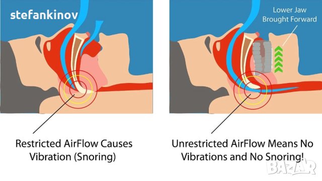 Шина назъбник за уста против хъркане No More Snore, снимка 3 - Други - 42497599
