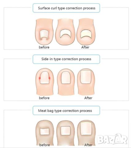 Лепенки за Нокът Агресивно Обработване на Кожната Гънка Прекомерно Излагане на Вода Чоплене Гризане