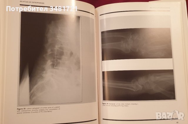 Атлас на остеопорозата / Atlas of Osteoporosis, снимка 8 - Енциклопедии, справочници - 41376795