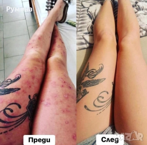 Пчелен мехлем срещу псориазис и екземи. , снимка 2 - Други - 49271882