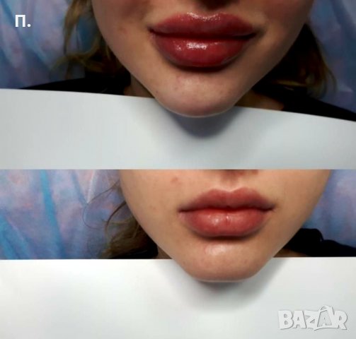 5мл. Филър за инжектор ПЕН, снимка 5 - Козметика за лице - 34778990