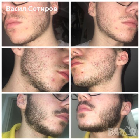 Minoxidil 10% Миноксидил спрей за растеж на брада и коса Миноксидил , снимка 7 - Продукти за коса - 37955831