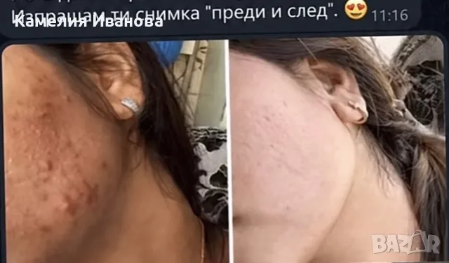 Избелваща Помада Алтън , снимка 6 - Козметика за тяло - 56151384