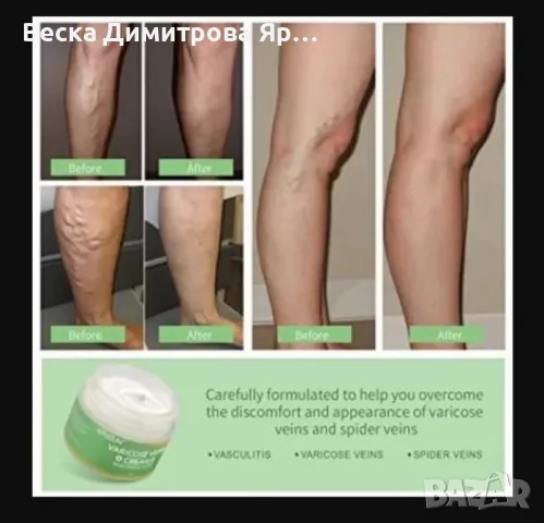 Лечебен крем с 6 билки за разширени вени и проблеми с краката HZS02, снимка 3 - Козметика за тяло - 47729574