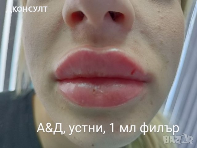 Хиалуронов Филър Juvederm Ultra 3, поставяне,лице , снимка 6 - Медицински, стоматологични - 41443858