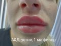 Хиалуронов Филър Juvederm Ultra 3, поставяне,лице , снимка 6