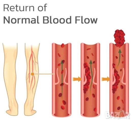 Пластири за Разширени Вени Крака Тромби Венозна Тромбоза Тромбофлебит Варикотромбофлебит Перифлебит, снимка 6 - Други - 41329323
